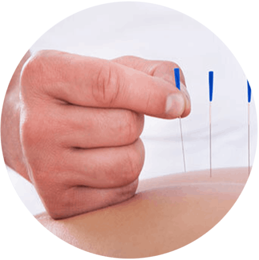 Dry Needling